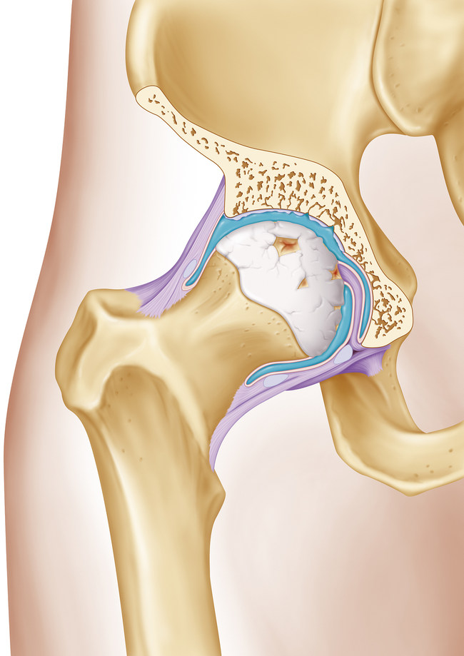 Câteva cuvinte despre reumatism